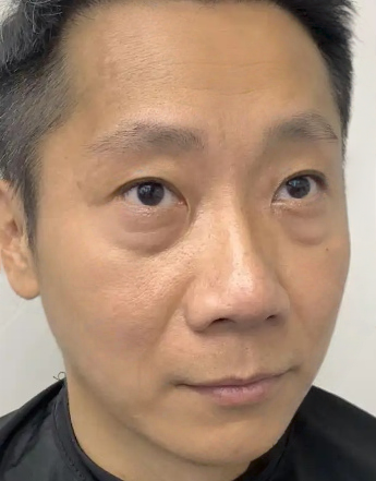 去眼袋手术