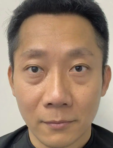 去眼袋手术