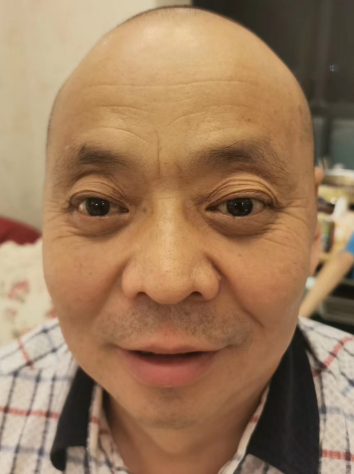 去眼袋手术