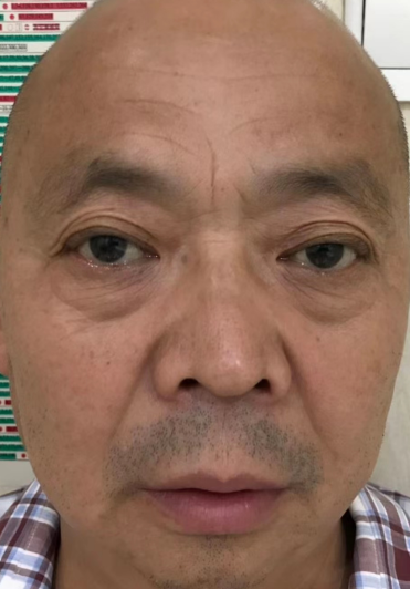 去眼袋手术