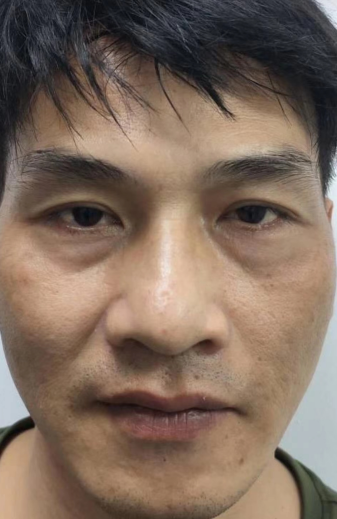 去眼袋手术