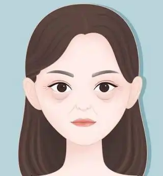 去眼袋手术