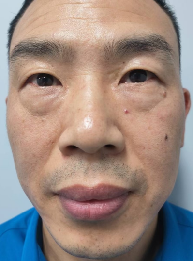去眼袋手术