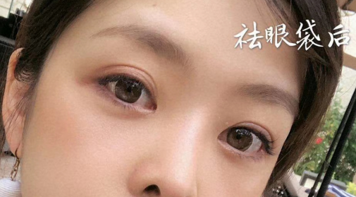 去眼袋手术