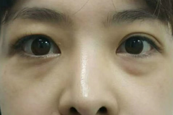 去眼袋手术