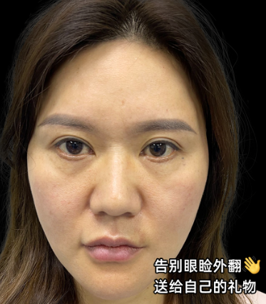 眼袋