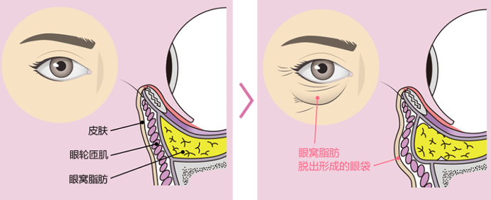 去眼袋手术