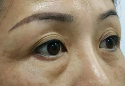 去眼袋手术