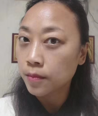去眼袋手术