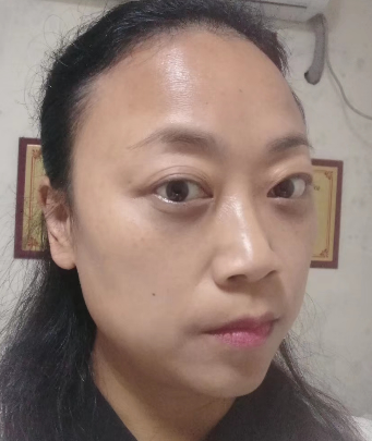 去眼袋手术
