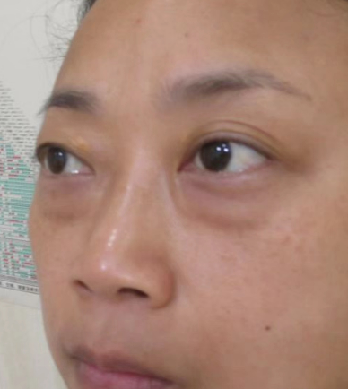 去眼袋手术