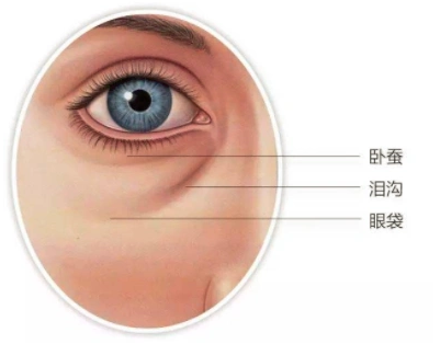 去眼袋手术