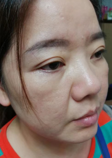 去眼袋手术