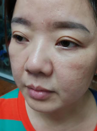 去眼袋手术