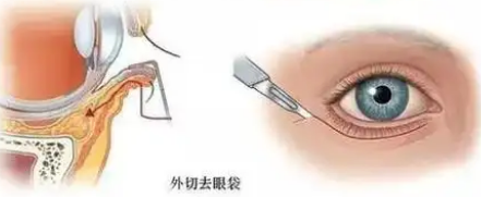 去眼袋手术