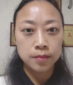 去眼袋手术