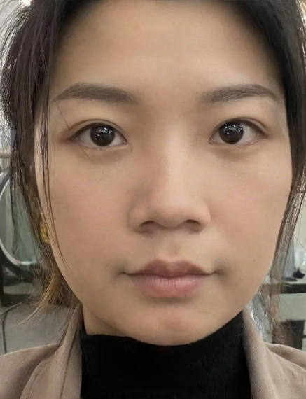 去眼袋手术