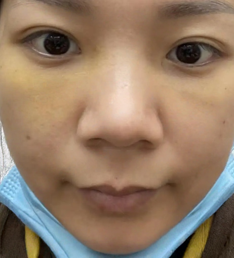 去眼袋手术