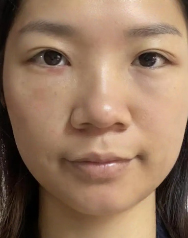 去眼袋手术