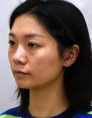 去眼袋手术