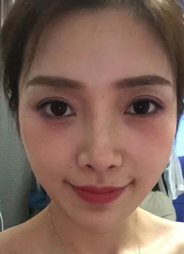 去眼袋手术