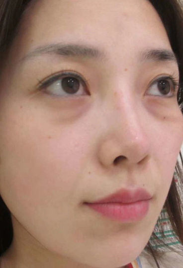 去眼袋手术