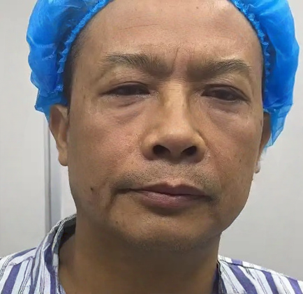 去眼袋手术