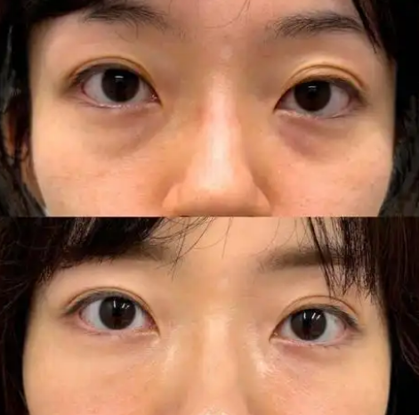 去眼袋手术