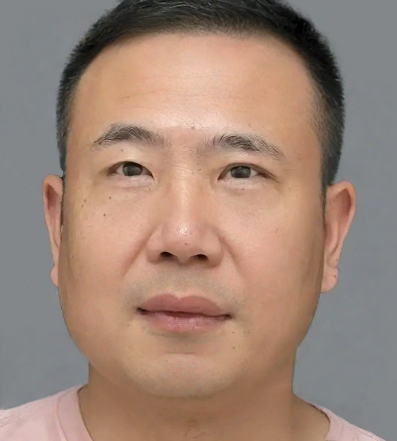 去眼袋手术