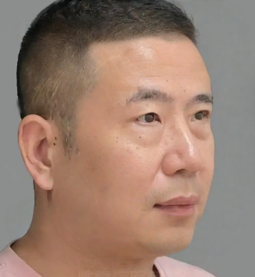去眼袋手术