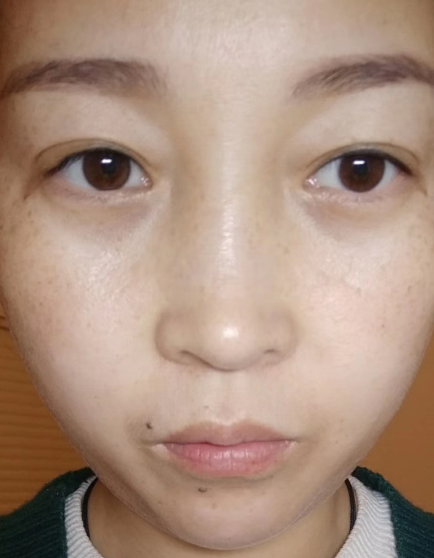 去眼袋手术