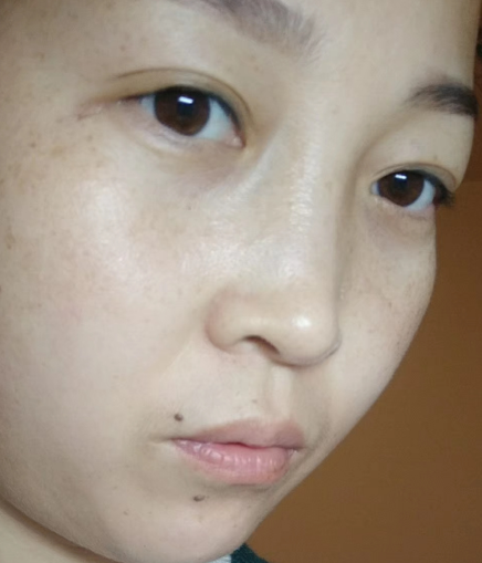 去眼袋手术