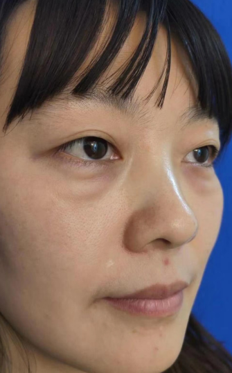去眼袋手术