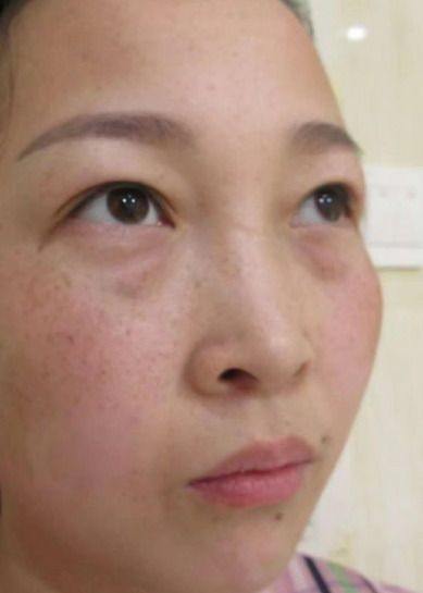 去眼袋手术