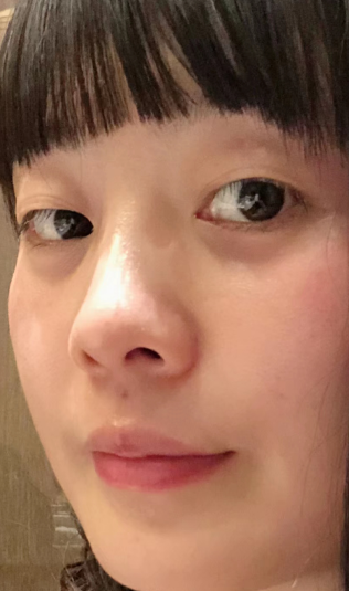 去眼袋手术