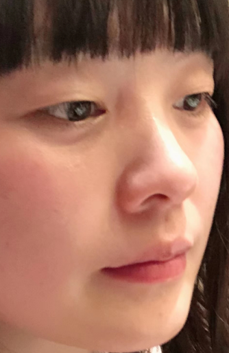 去眼袋手术