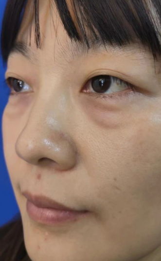 去眼袋手术