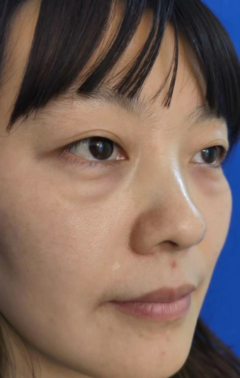 去眼袋手术