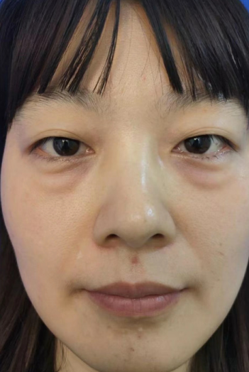 去眼袋手术