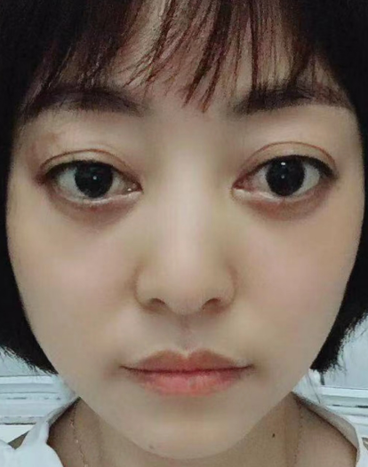 去眼袋手术