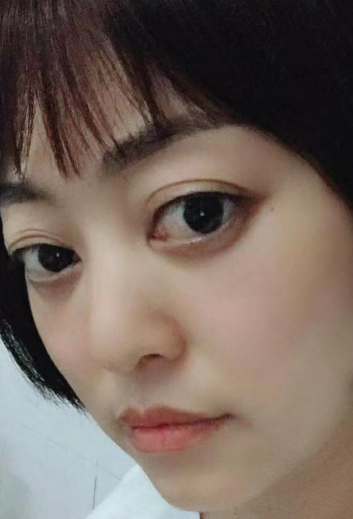 去眼袋手术
