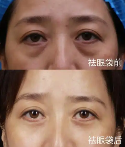 去眼袋手术