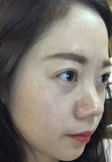 去眼袋手术