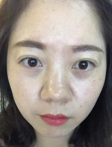 去眼袋手术