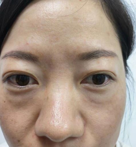 去眼袋手术