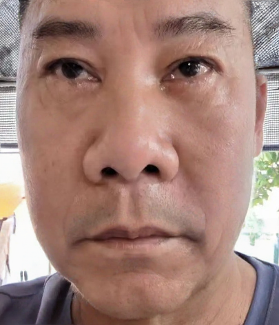 去眼袋手术