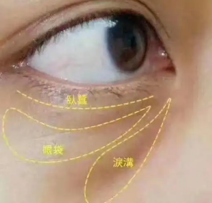 去眼袋手术