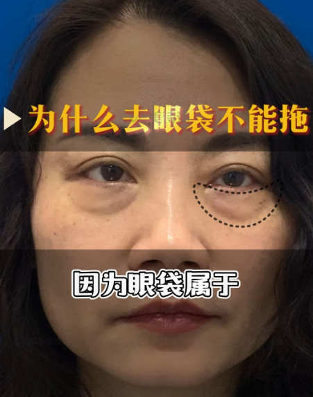 去眼袋手术