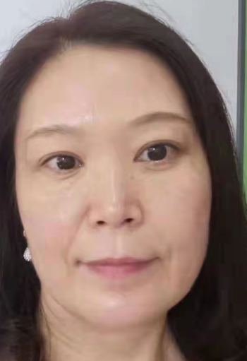 去眼袋手术