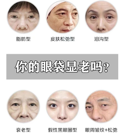 去眼袋手术